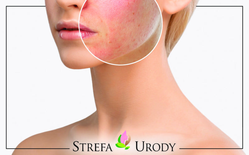 Uczulenie na kosmetyki