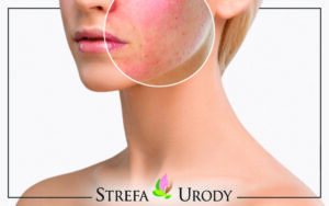 Skuteczne metody na uczulenie na kosmetyki – jak złagodzić objawy i odzyskać komfort